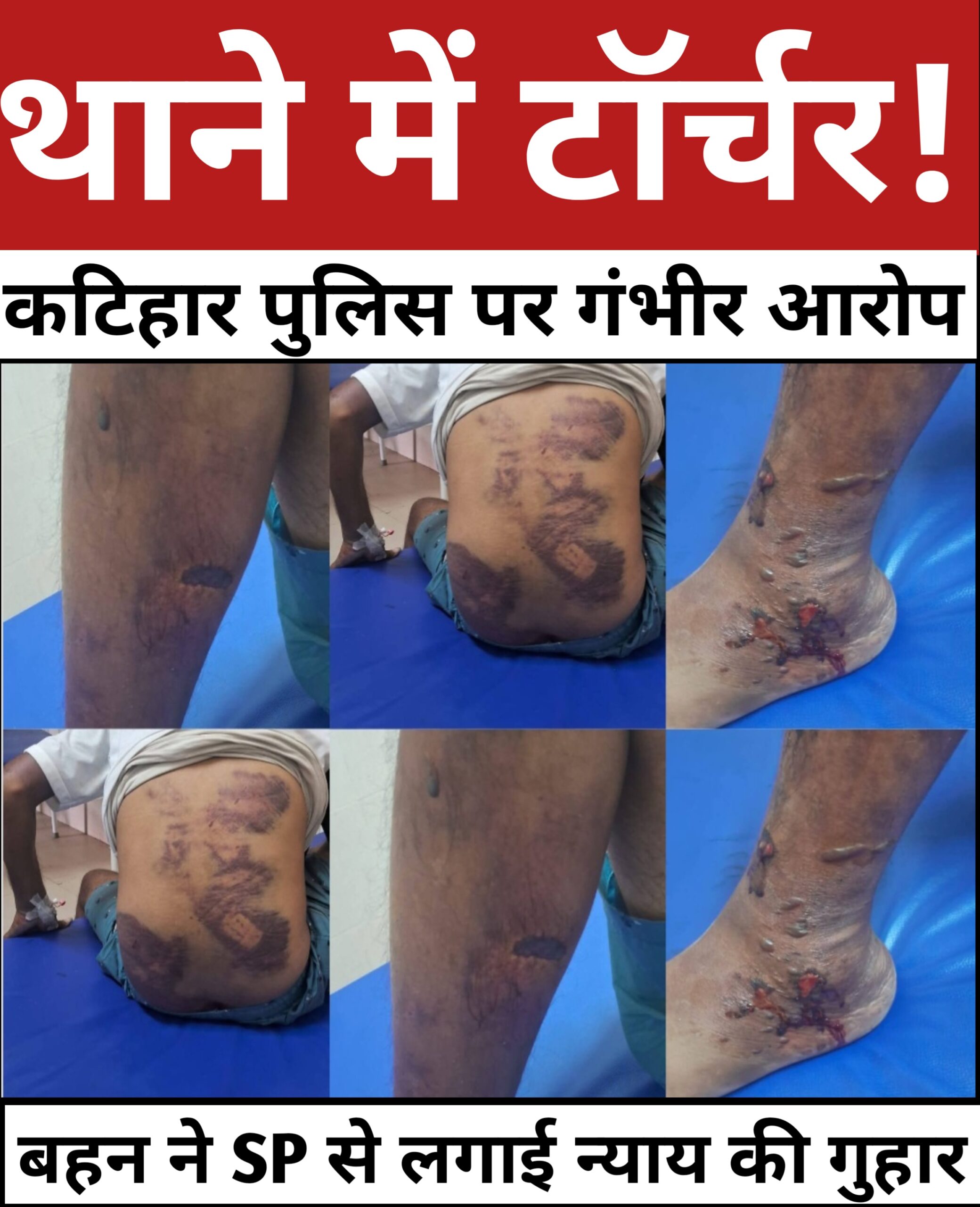 कटिहार में खाकी का कहर: मोबाइल चोरी के शक में युवक को थाने में पीट-पीटकर किया लहूलुहान!